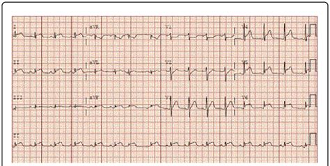 mild apical and septal hypokinesis.